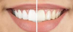 Are There Any Positive Effects of Teeth Whitening?