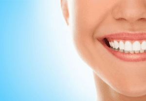 Understanding the Benefits and Process of Teeth Whitening